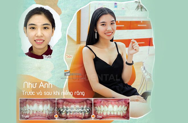 niềng răng cửa mất bao lâu