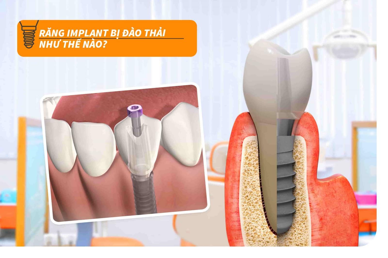 Răng Implant bị đào thải như thế nào?