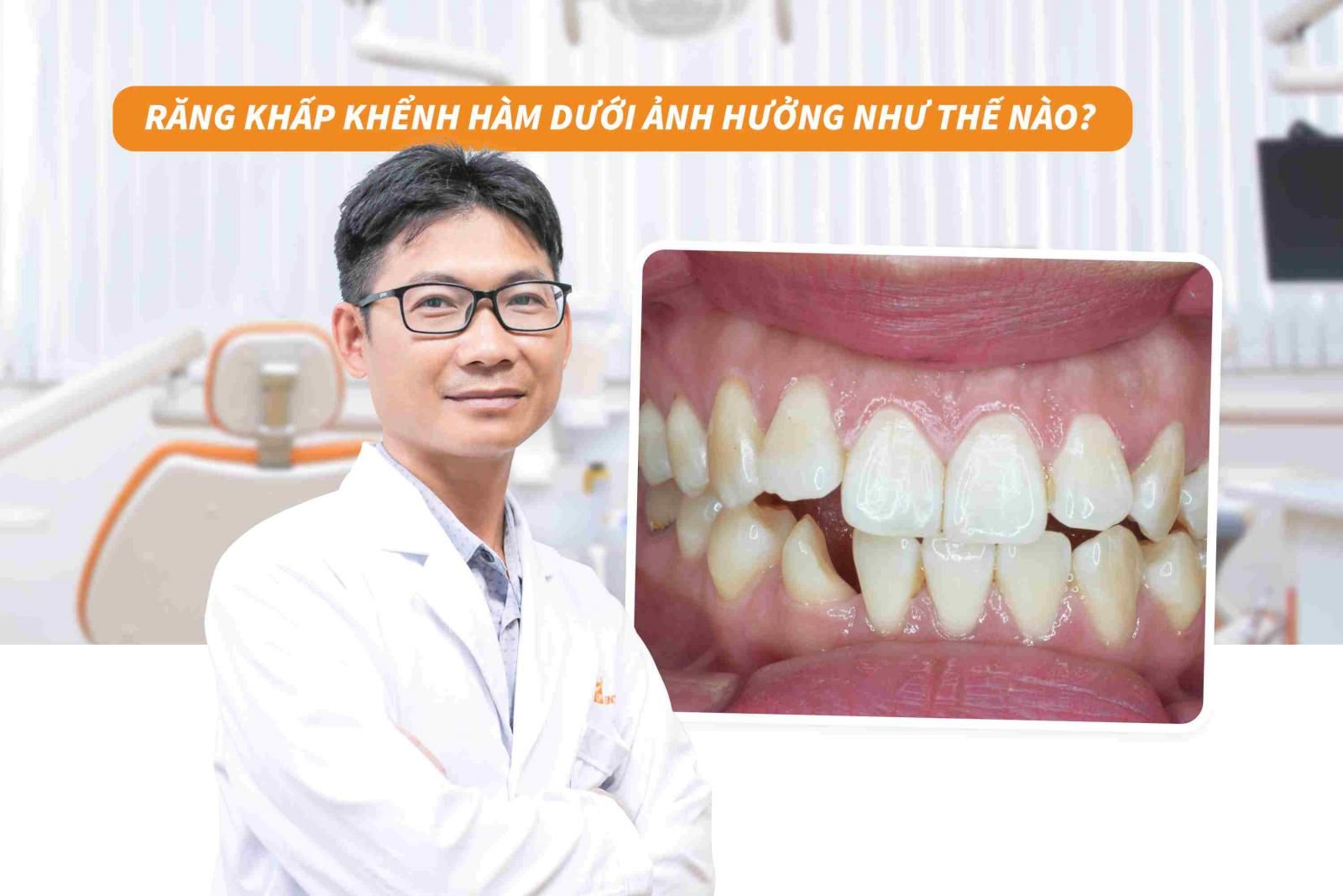 Răng khấp khểnh hàm dưới ảnh hưởng như thế nào