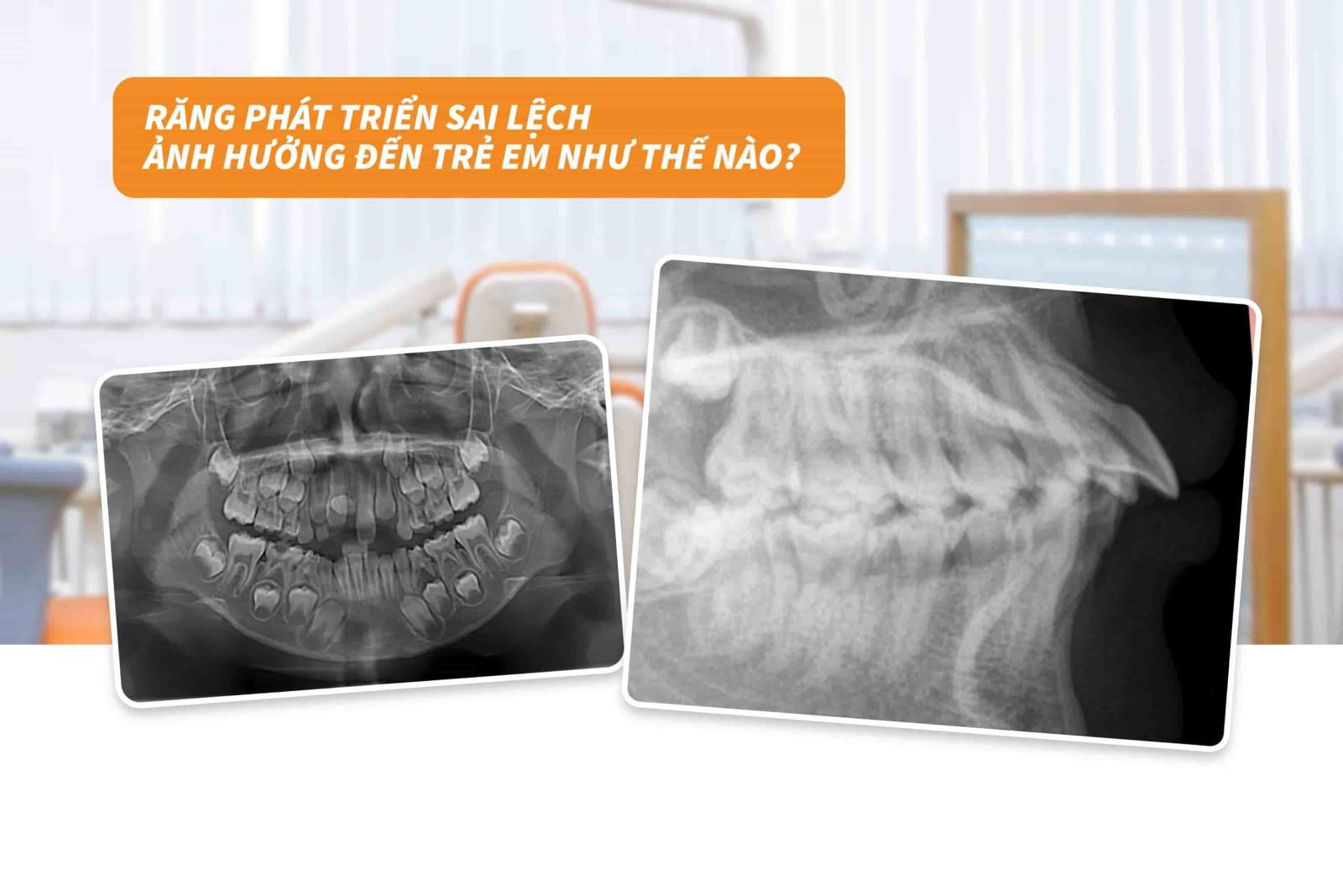 Răng phát triển sai lệch ảnh hưởng đến trẻ em như thế nào?