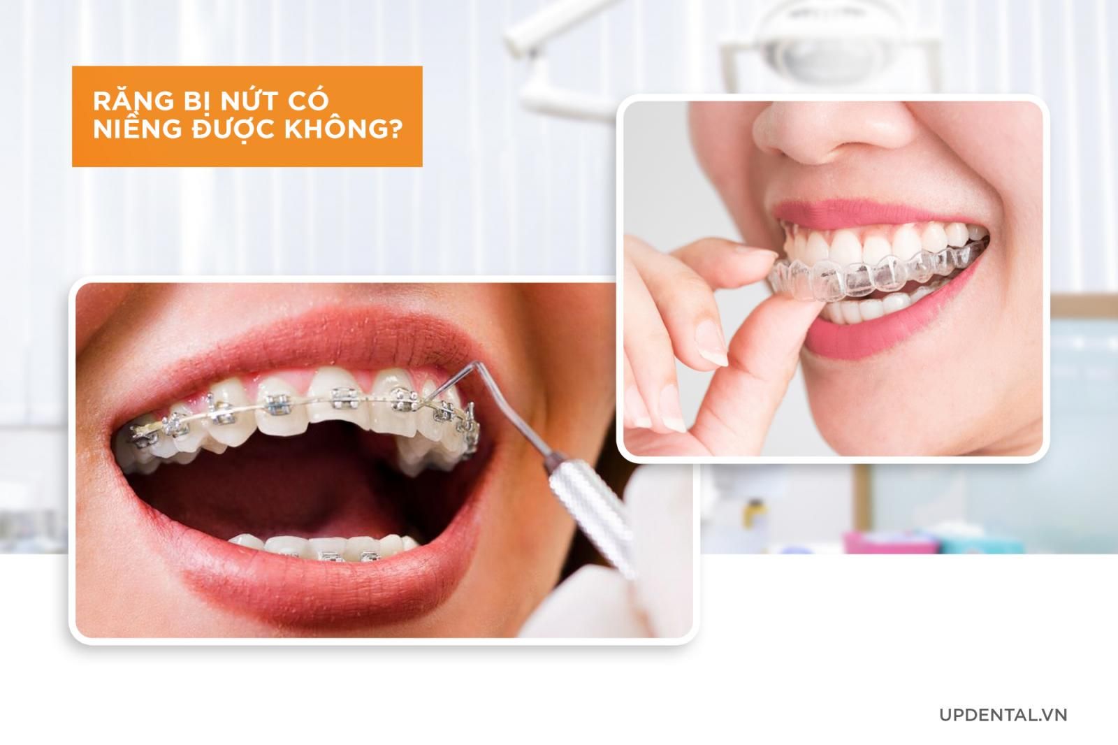 răng bị nứt có niềng răng được không