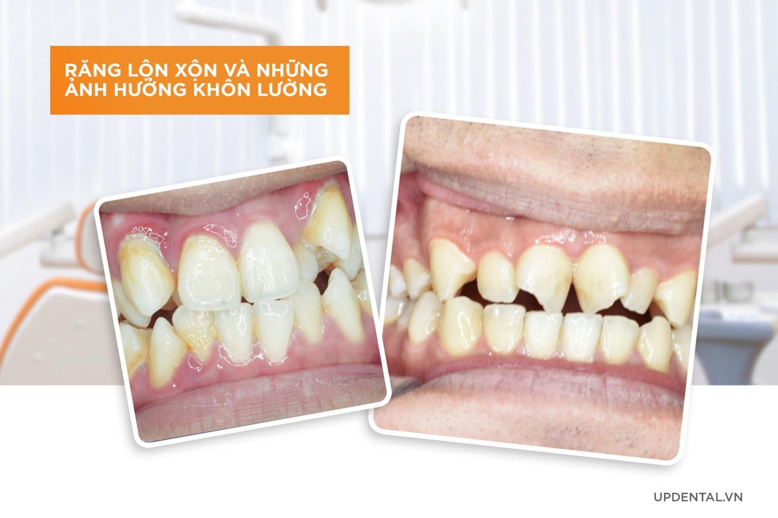 Răng lộn xộn và những ảnh hưởng