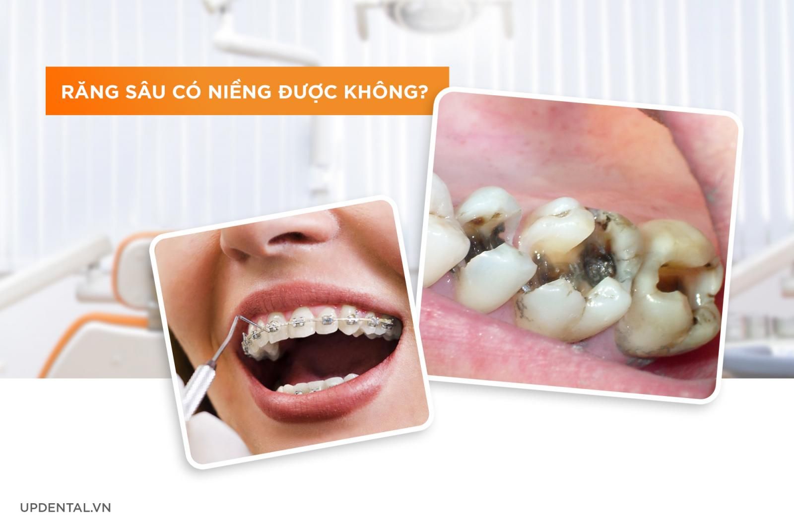 Răng sâu có niềng răng được không?