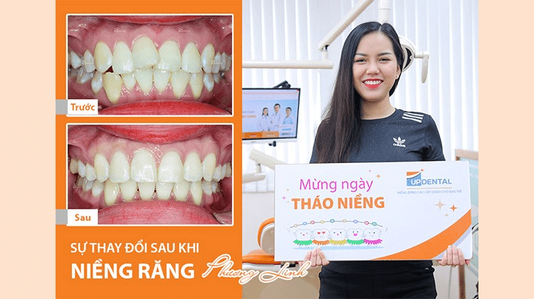 review khách hàng niềng răng sứ