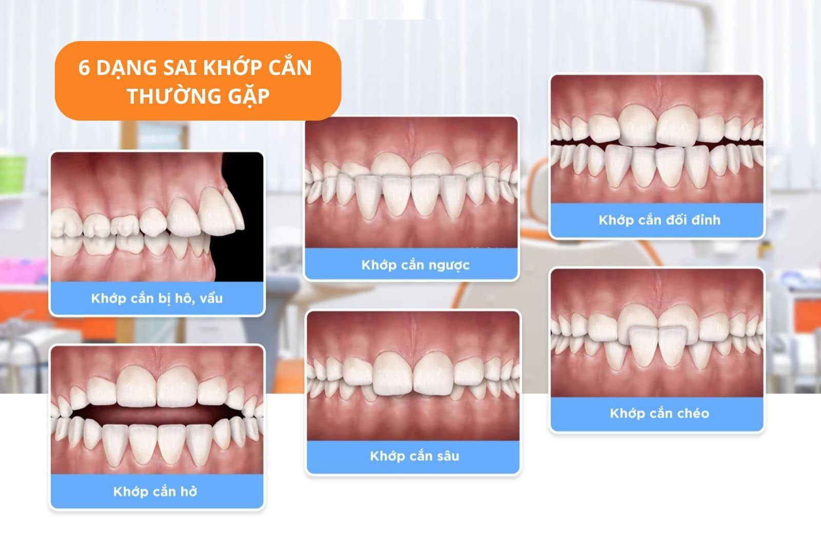 Sai khớp cắn là gì?