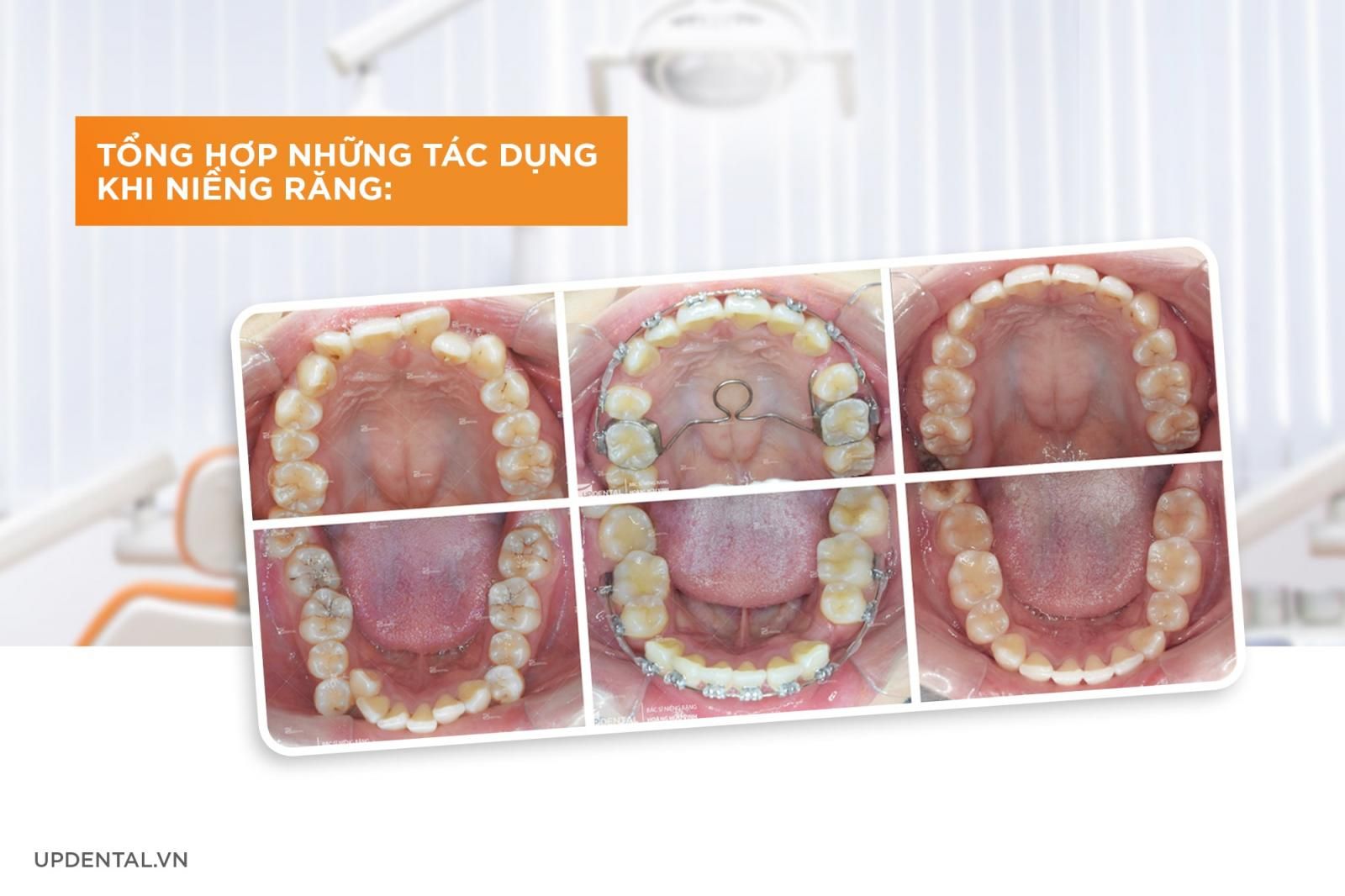 5 tác dụng của niềng răng