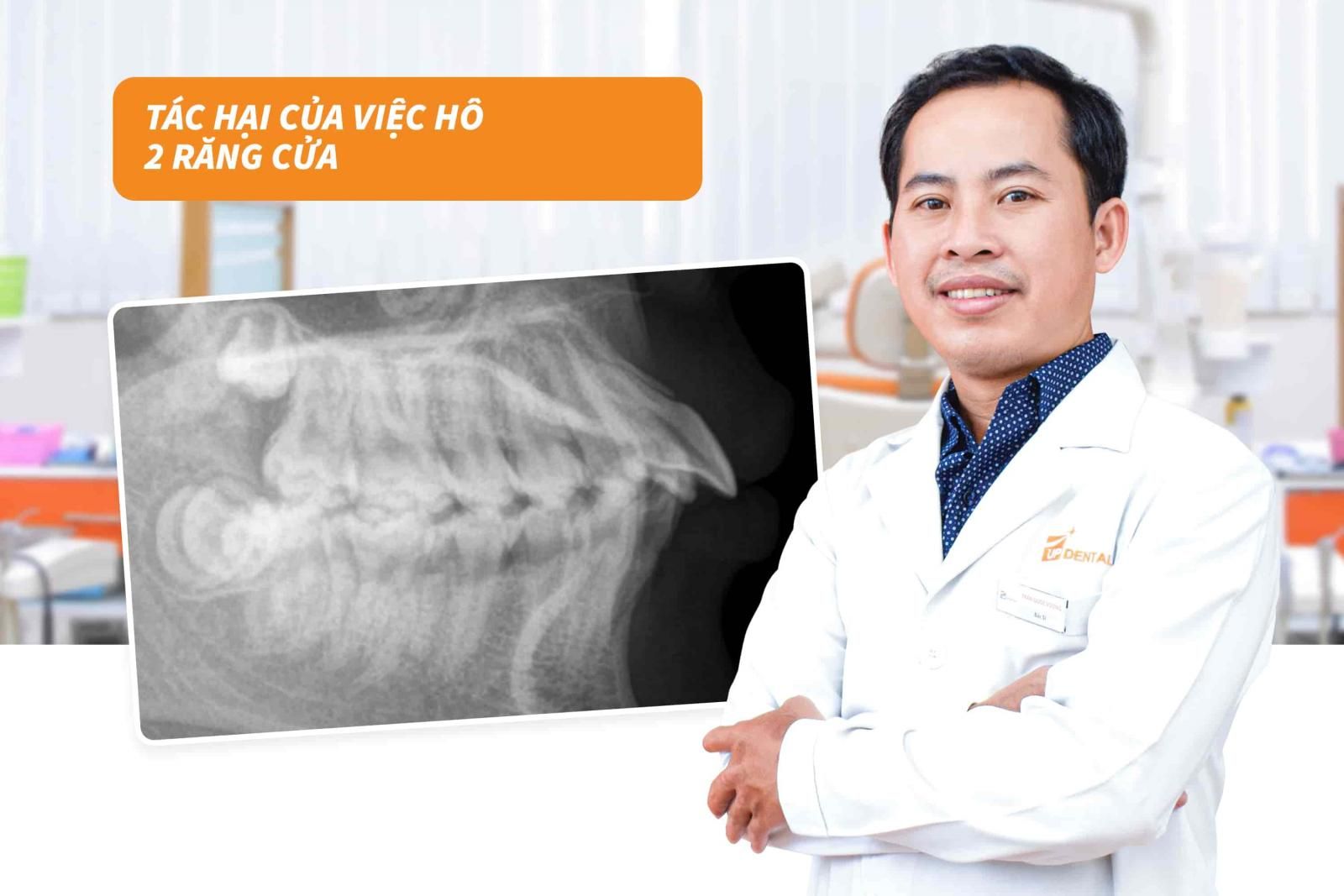 Tác hại của việc hô 2 răng cửa 