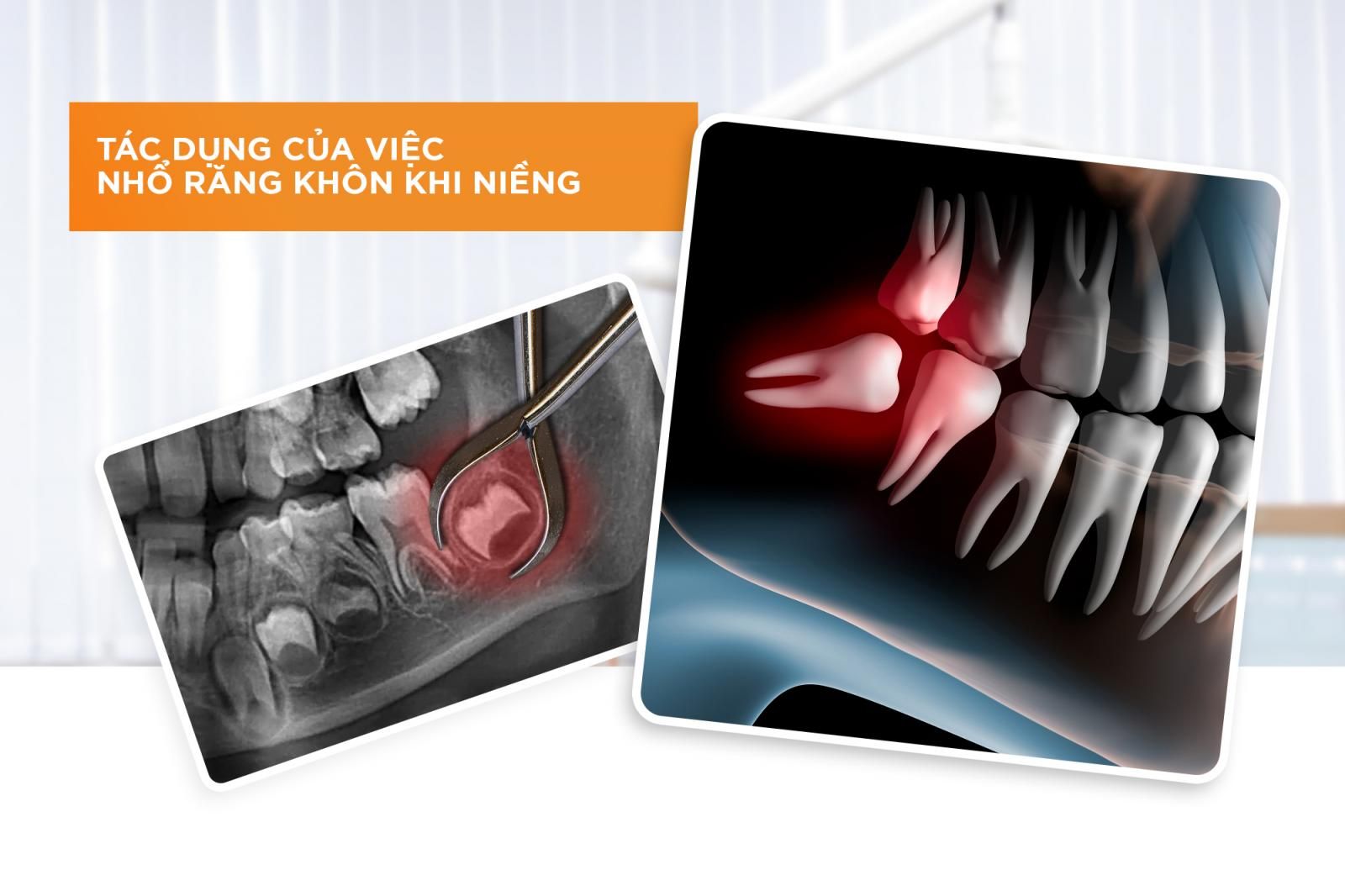 Tác dụng của việc nhổ răng khôn