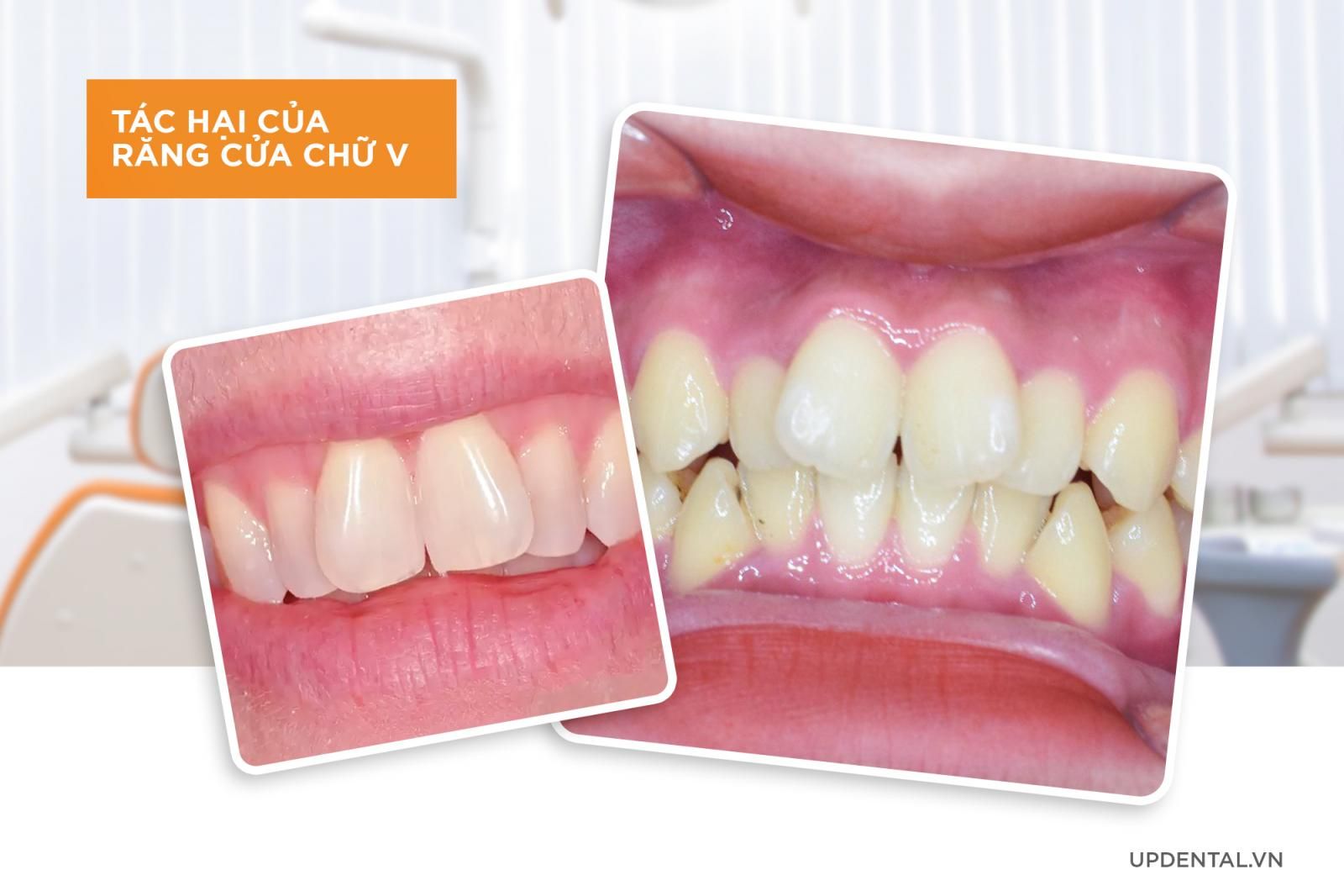 Tác hại của răng cửa chữ V