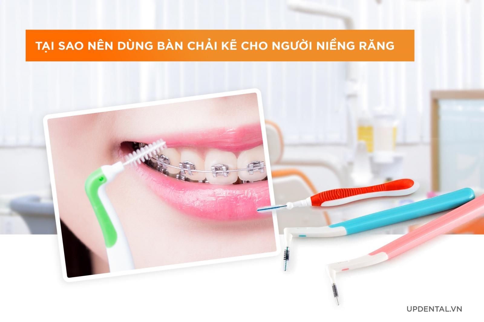 Tại sao nên dùng bàn chải kẽ cho người niềng răng?