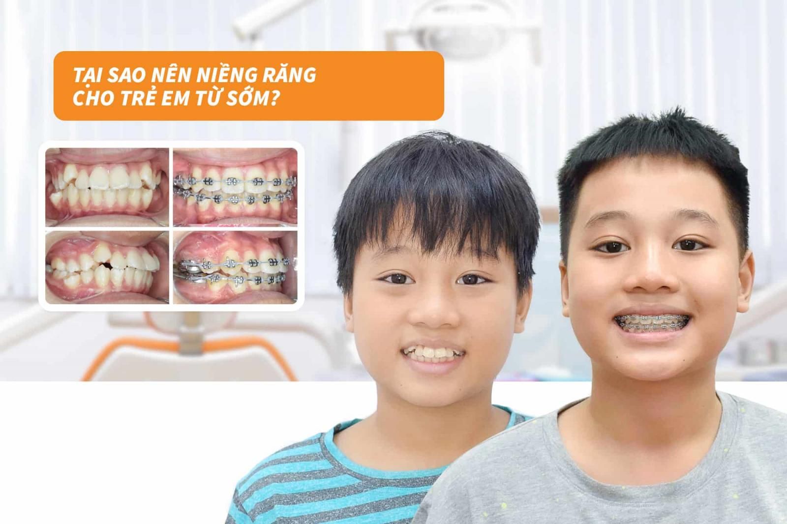 Tại sao nên niềng răng cho trẻ em từ sớm