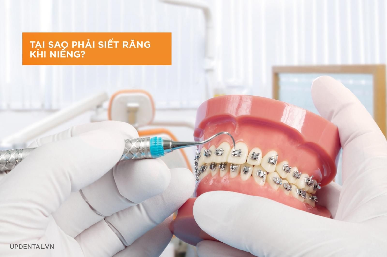 Tại sao phải siết răng khi niềng răng