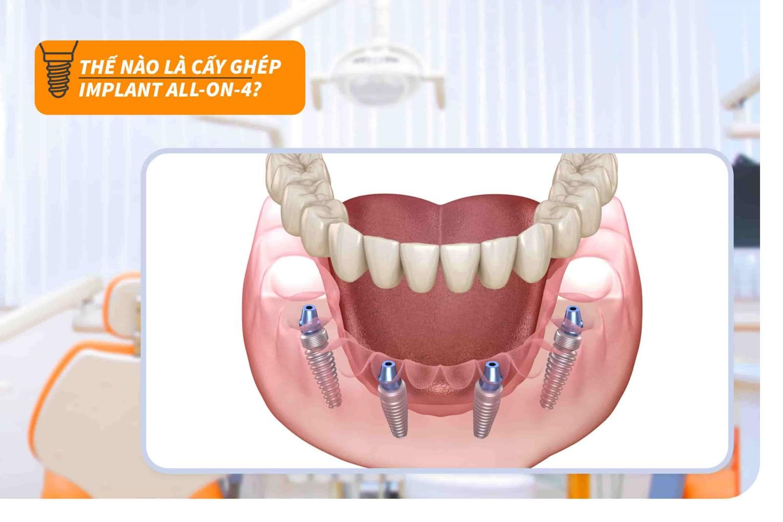 Thế nào là cấy ghép Implant All-on-4?