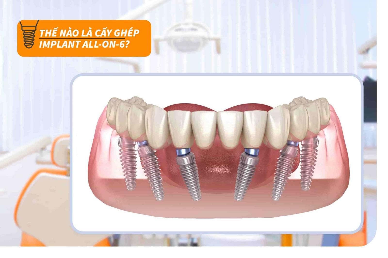 Thế nào là cấy ghép Implant all-on-6?