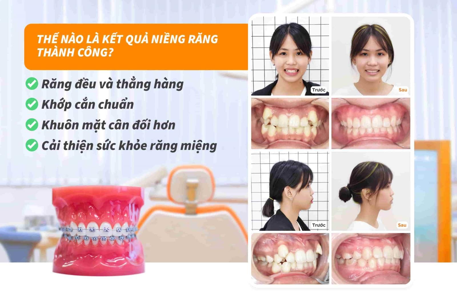 Thế nào là kết quả niềng răng thành công?