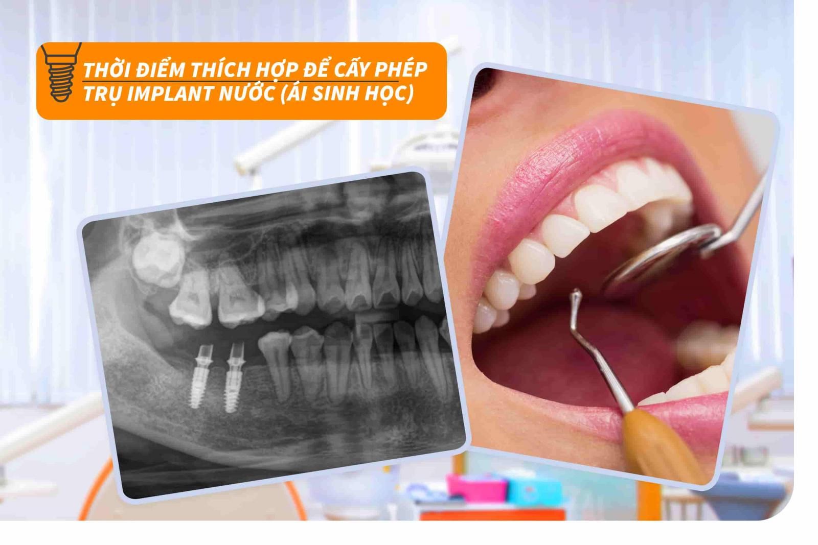 Thời điểm thích hợp để cấy ghép trụ Implant nước (Ái sinh học)