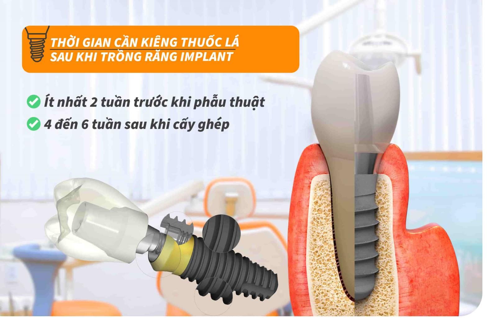 Thời gian cần kiêng thuốc lá sau khi trồng răng Implant