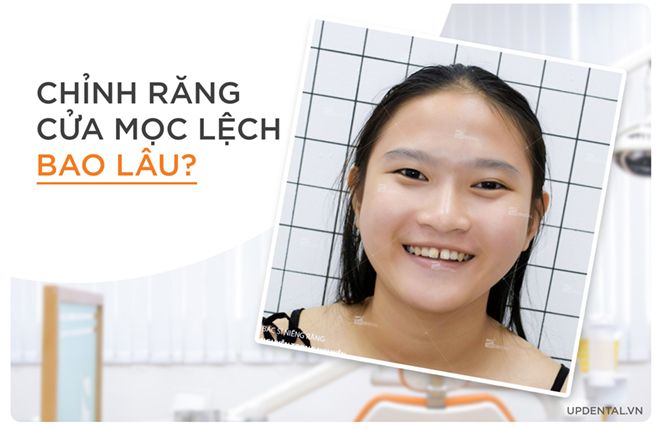 niềng răng cửa mọc lệch trong bao lâu