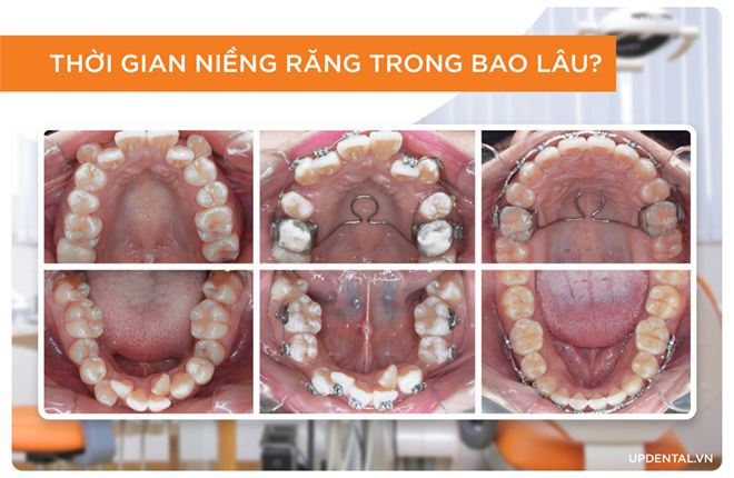 thời gian niềng răng trong bao lâu