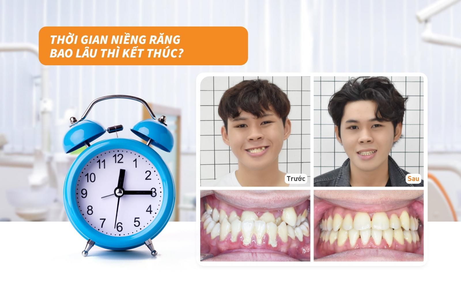 Thời gian niềng răng bao lâu thì kết thúc