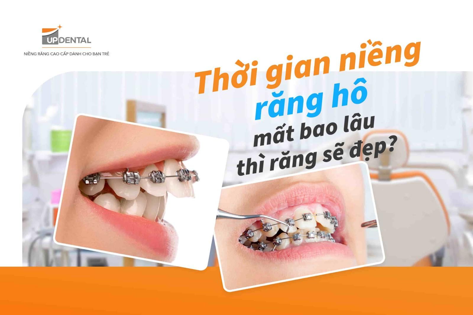 Thời gian niềng răng hô bao lâu?