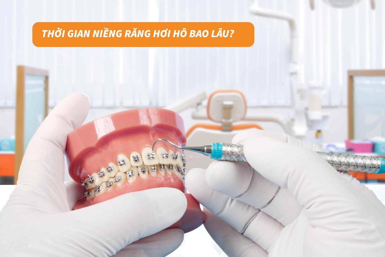 Thời gian niềng răng hơi hô bao lâu?