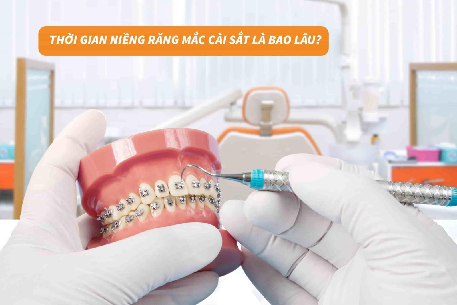 Thời gian niềng răng mắc cài sắt là bao lâu?