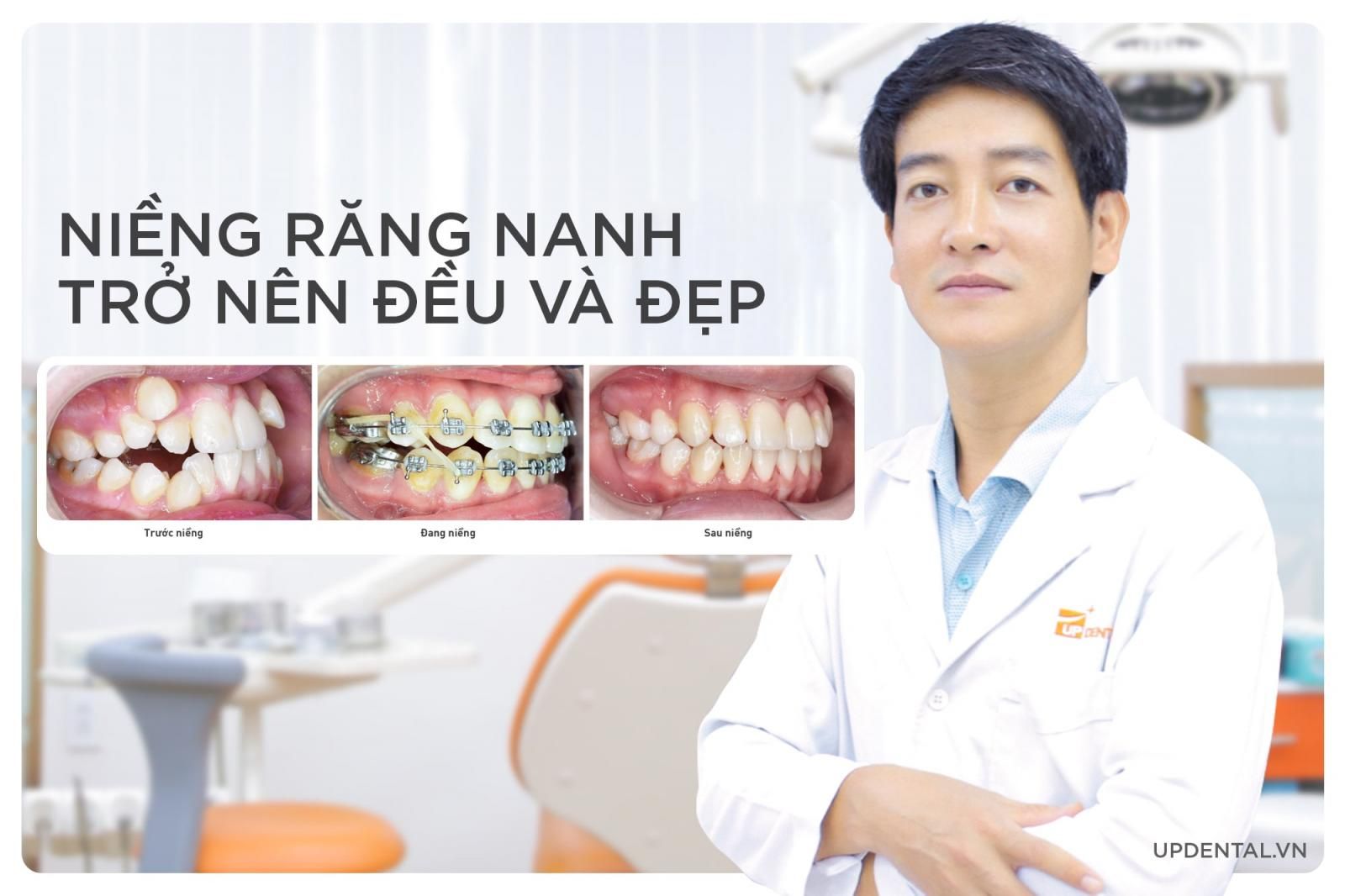 thời gian niềng răng nanh