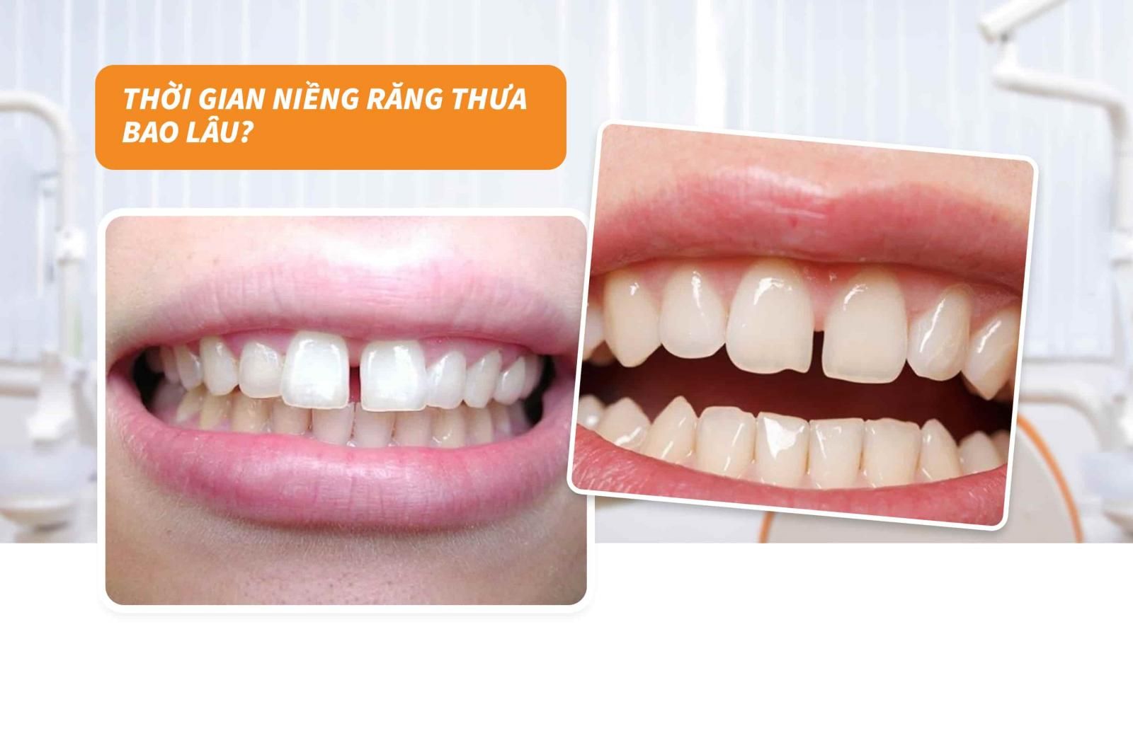 Thời gian niềng răng thưa bao lâu?