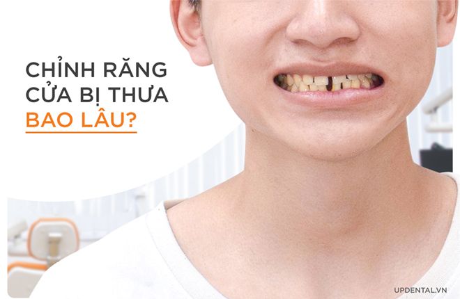 niềng răng cửa bị thưa bao lâu