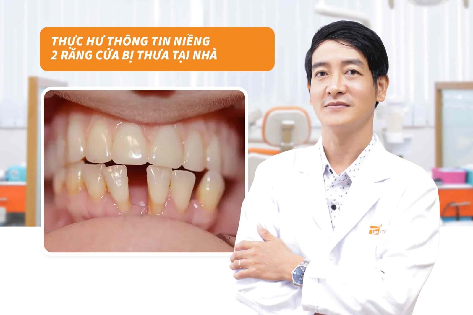 Thực hư thông tin niềng 2 răng cửa bị thưa tại nhà 