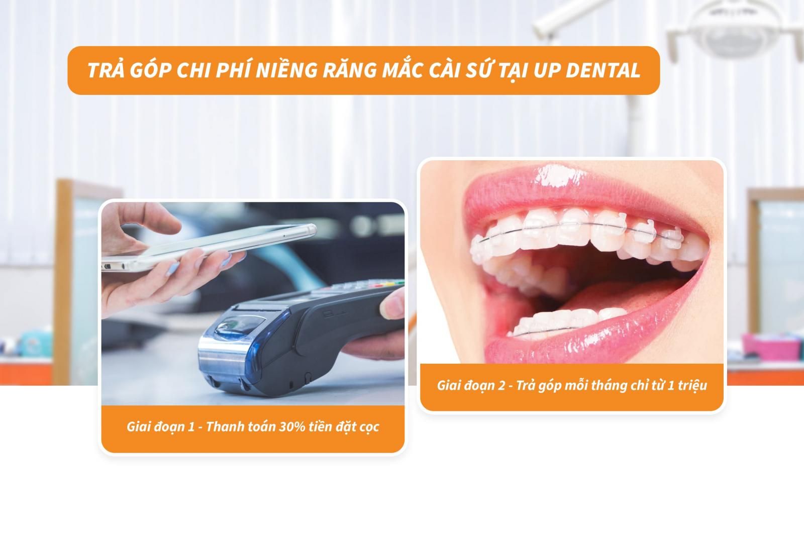 Trả góp chi phí niềng răng mắc cài sứ tại Up Dental