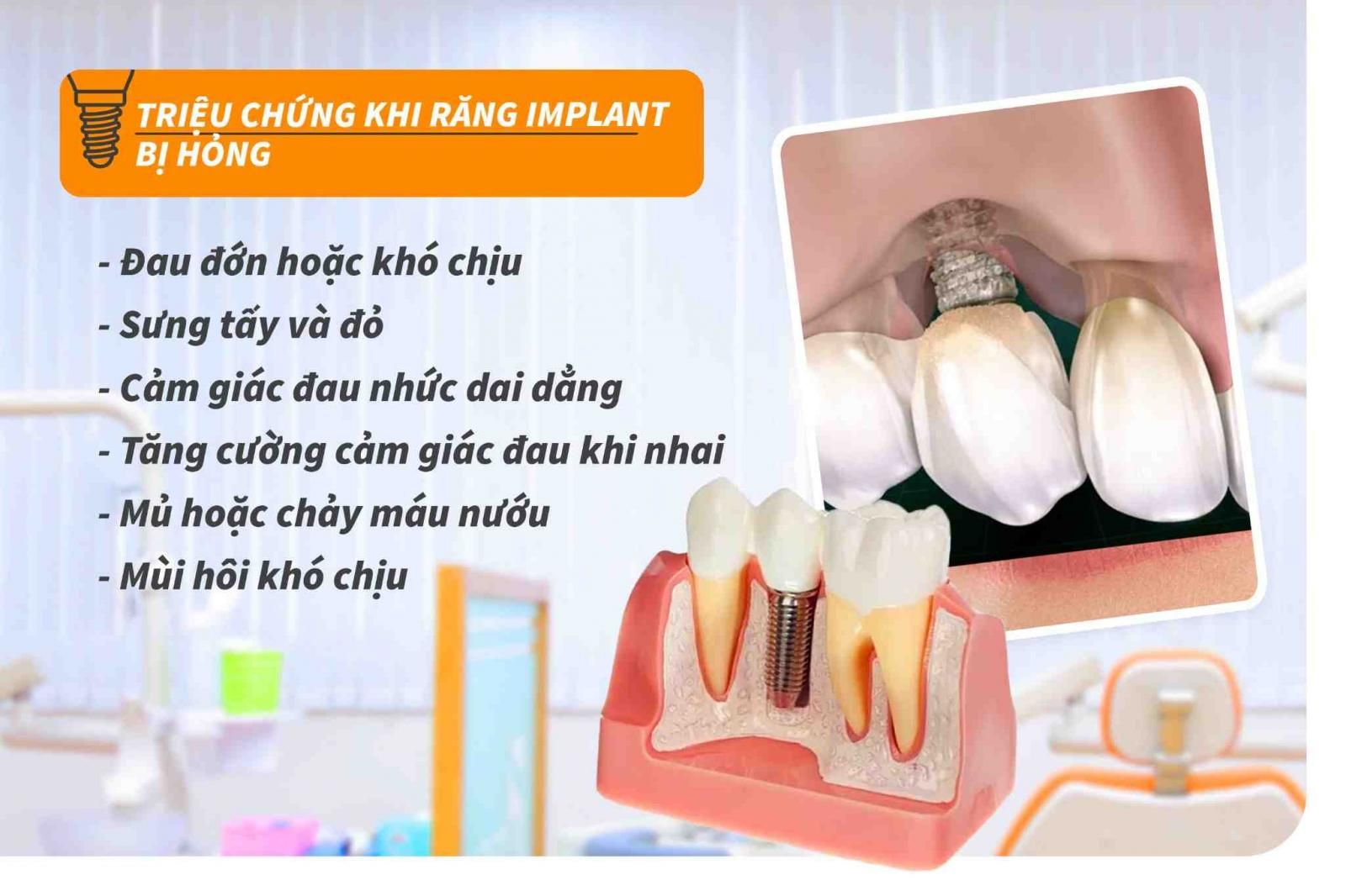 Triệu chứng khi răng Implant bị hỏng