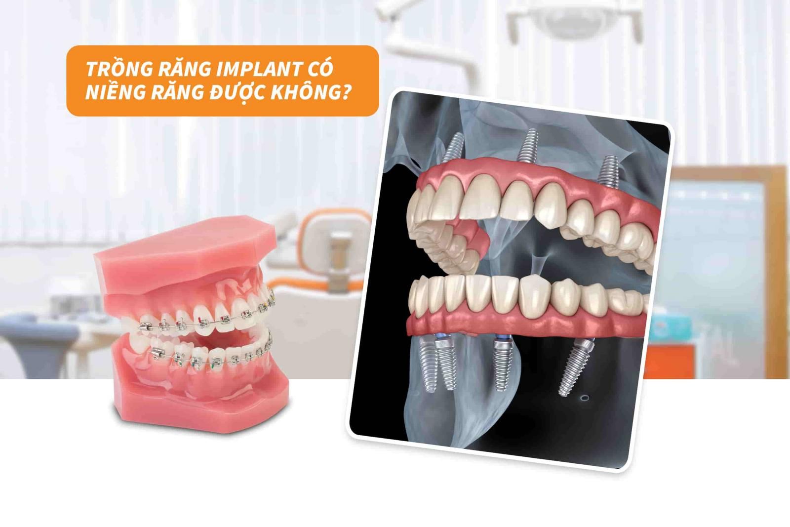 Trồng răng implant có niềng răng được không?