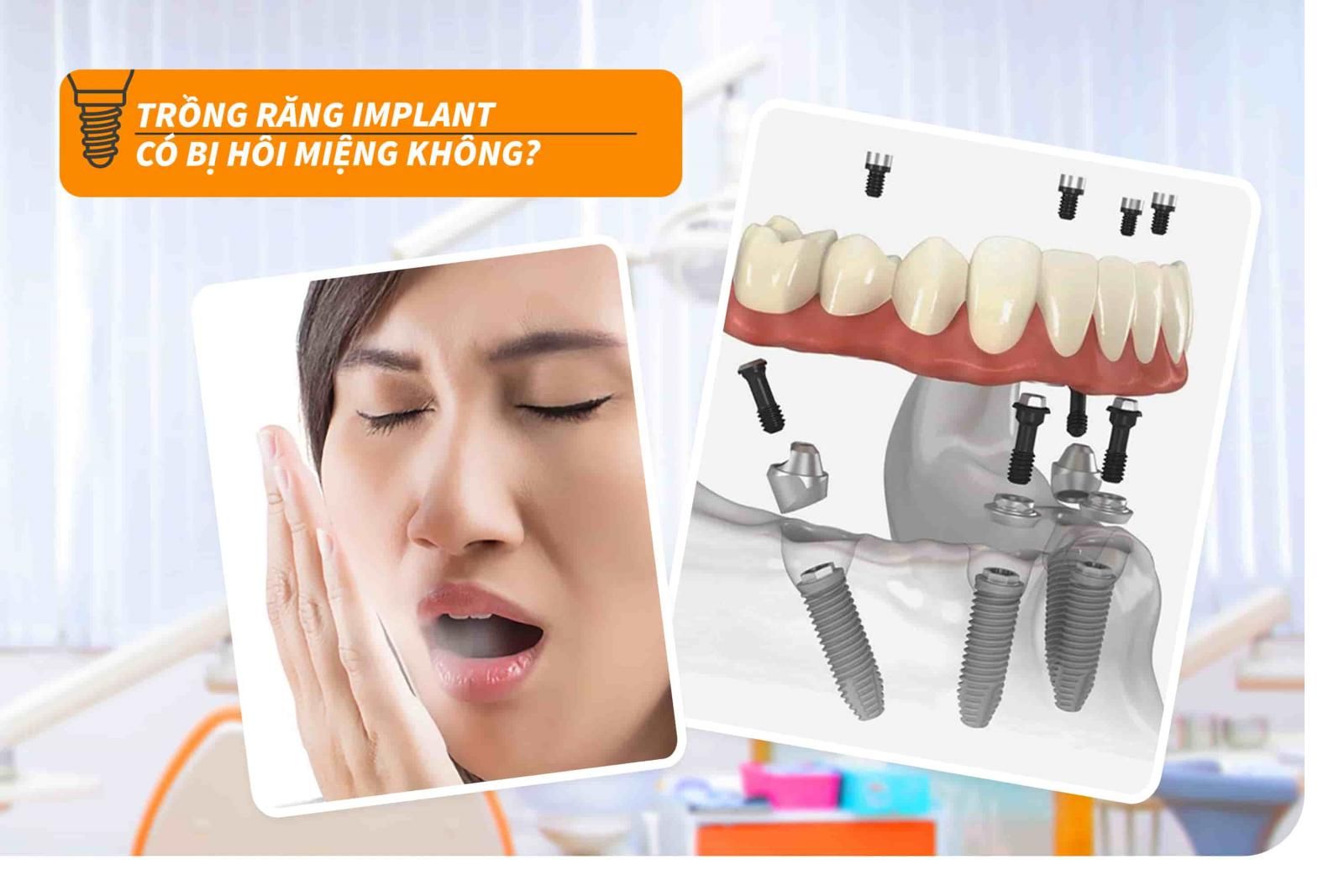 Trồng răng Implant có bị hôi miệng không?