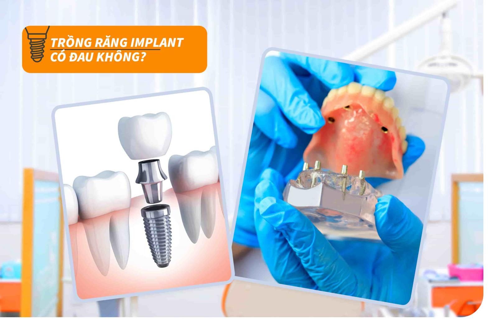 Trồng răng Implant có đau không?