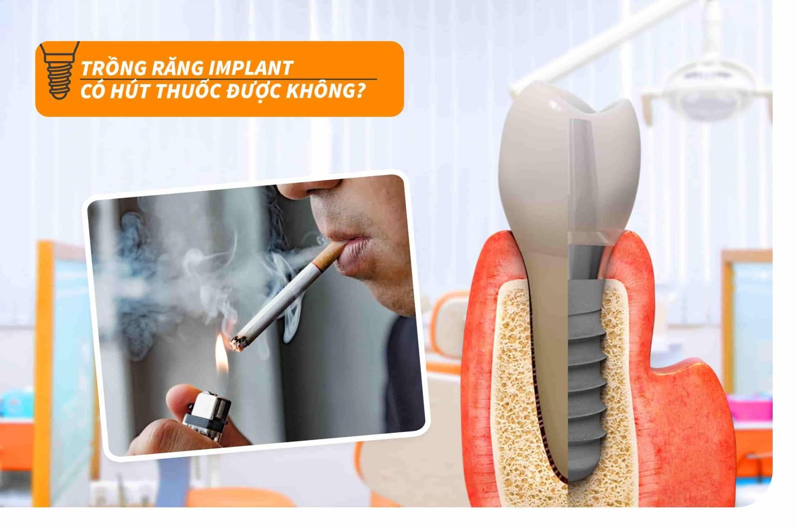 Trồng răng Implant có hút thuốc được không?