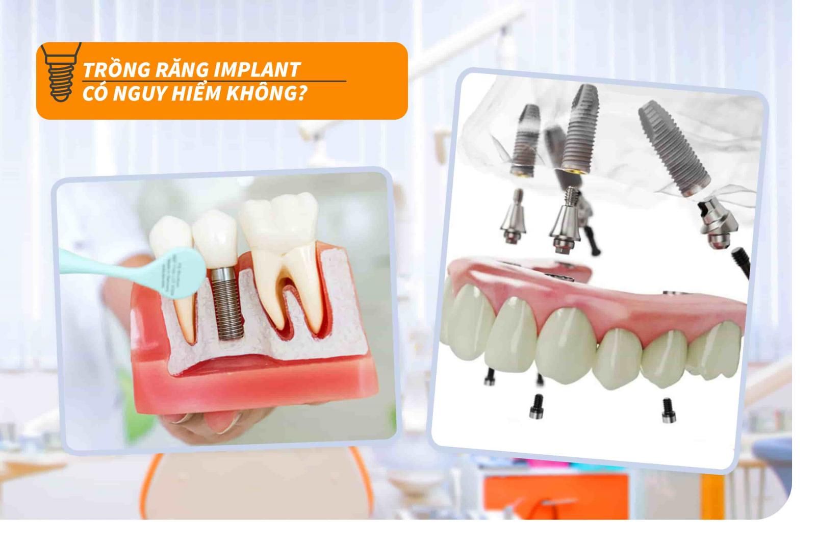 Trồng răng Implant có nguy hiểm không?