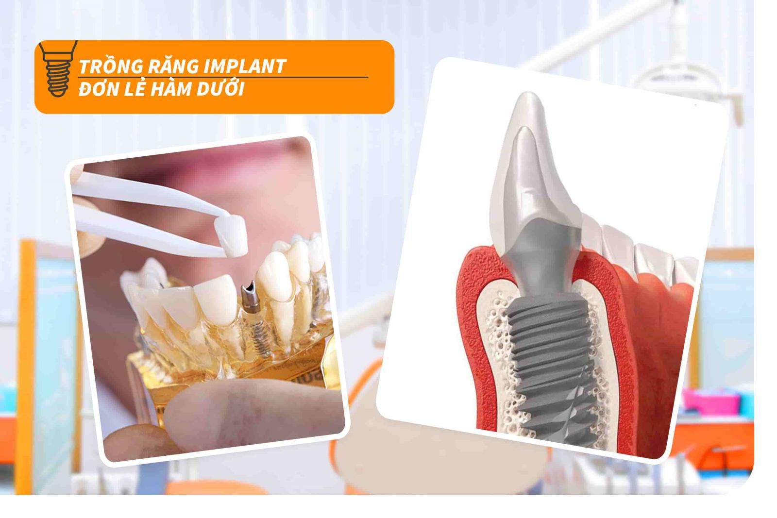 Trồng răng Implant đơn lẻ hàm dưới