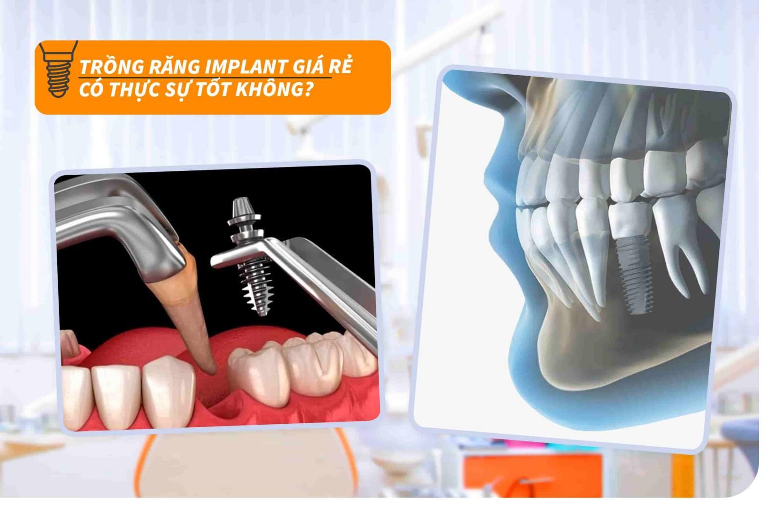 Trồng răng Implant giá rẻ có thực sự tốt không?