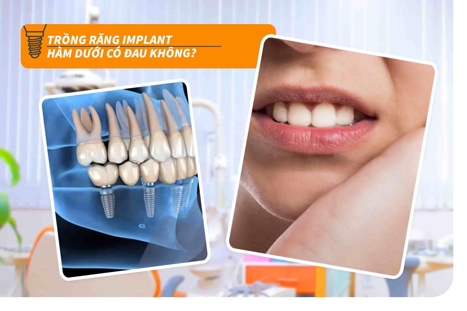 Trồng răng Implant hàm dưới có đau không?