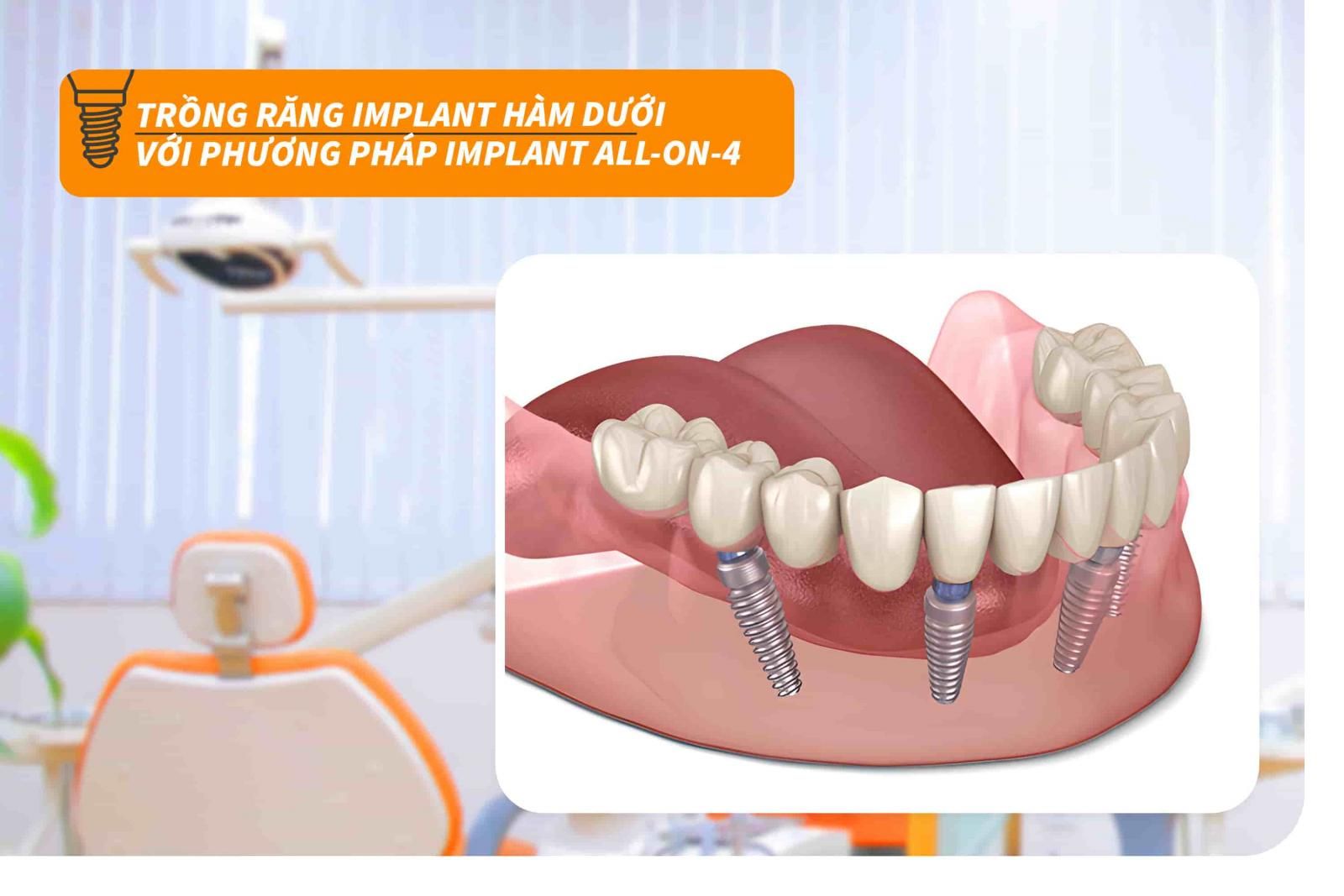 Trồng răng Implant hàm dưới với phương pháp Implant All-on-4