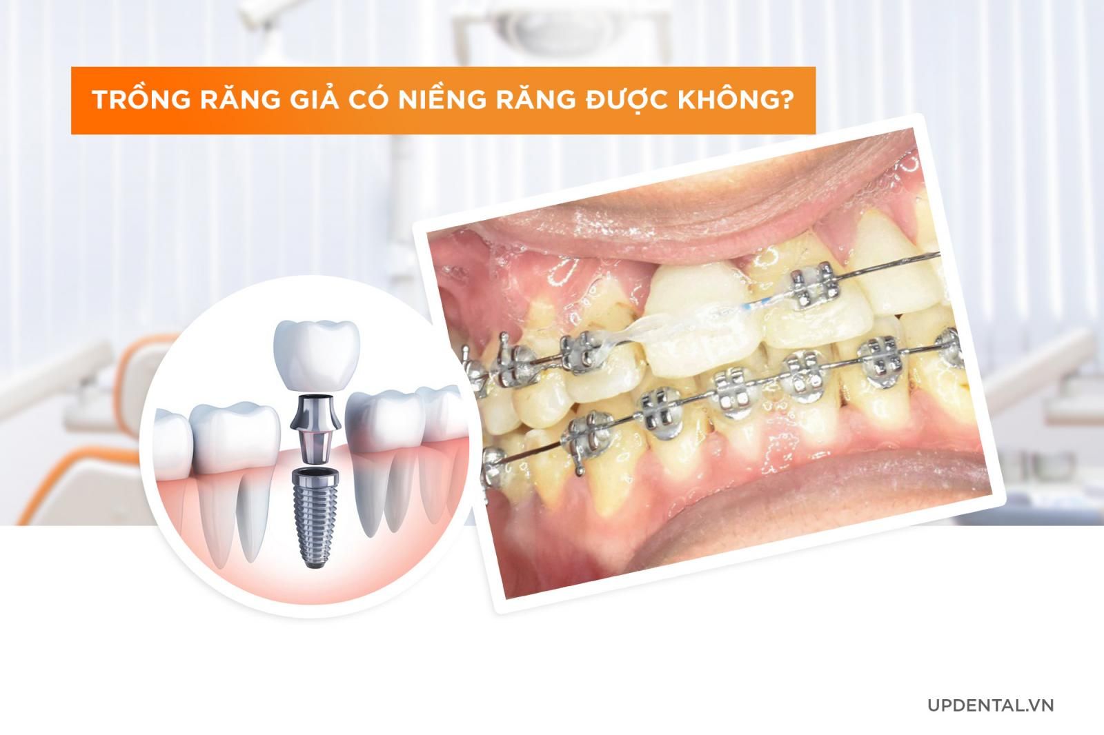 Trồng răng giả có niềng răng được không