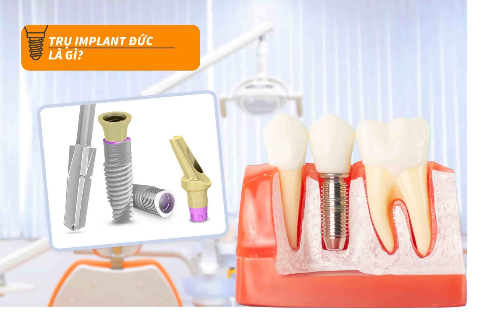 Trụ Implant Đức là gì?