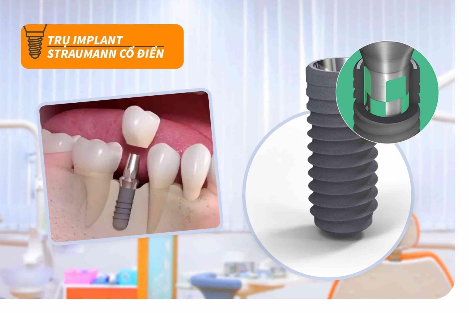 Trụ Implant Straumann SLA® cổ điển