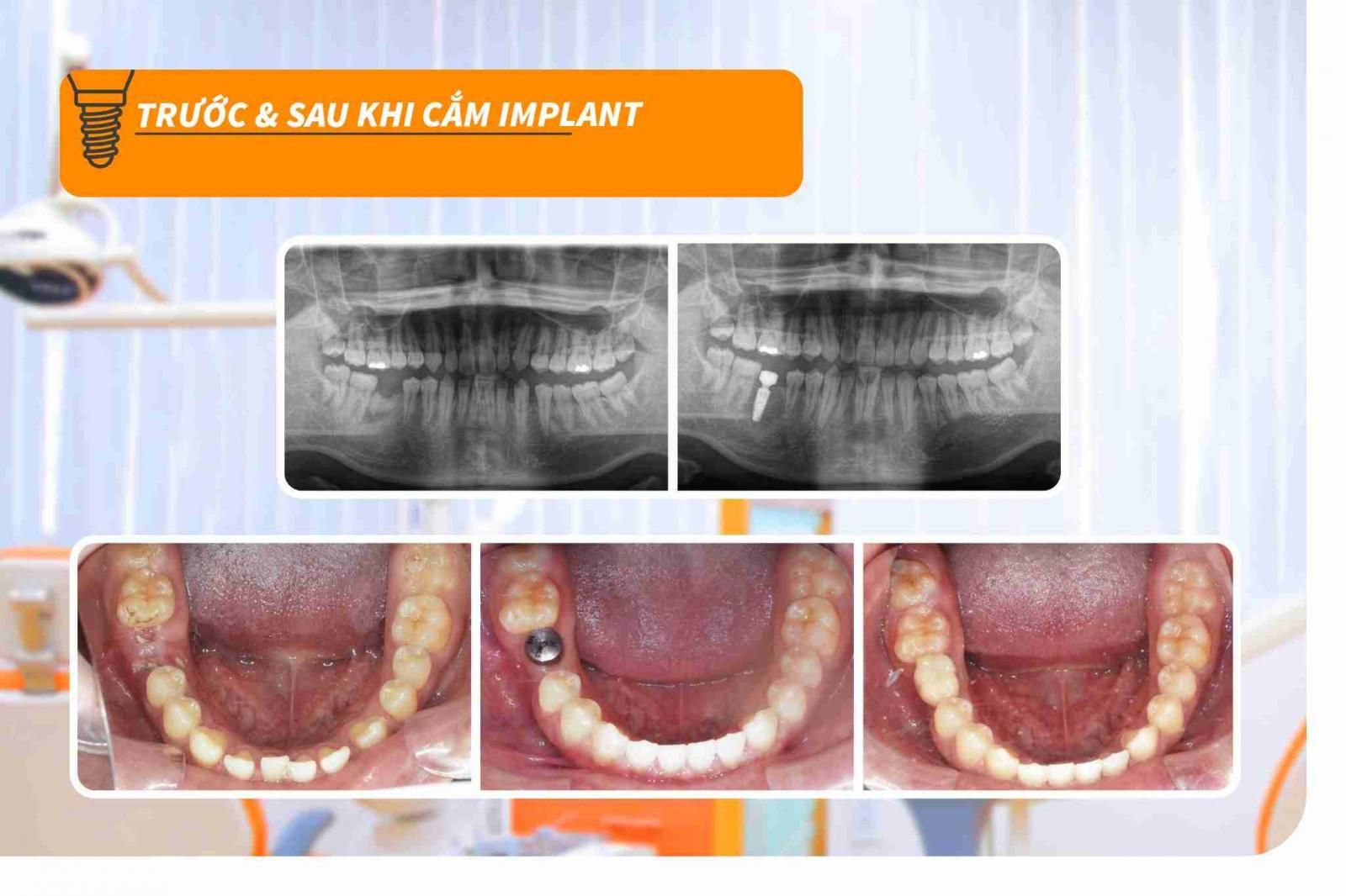 Hình ảnh cấy ghép Implant của Khách hàng tại Up Dental