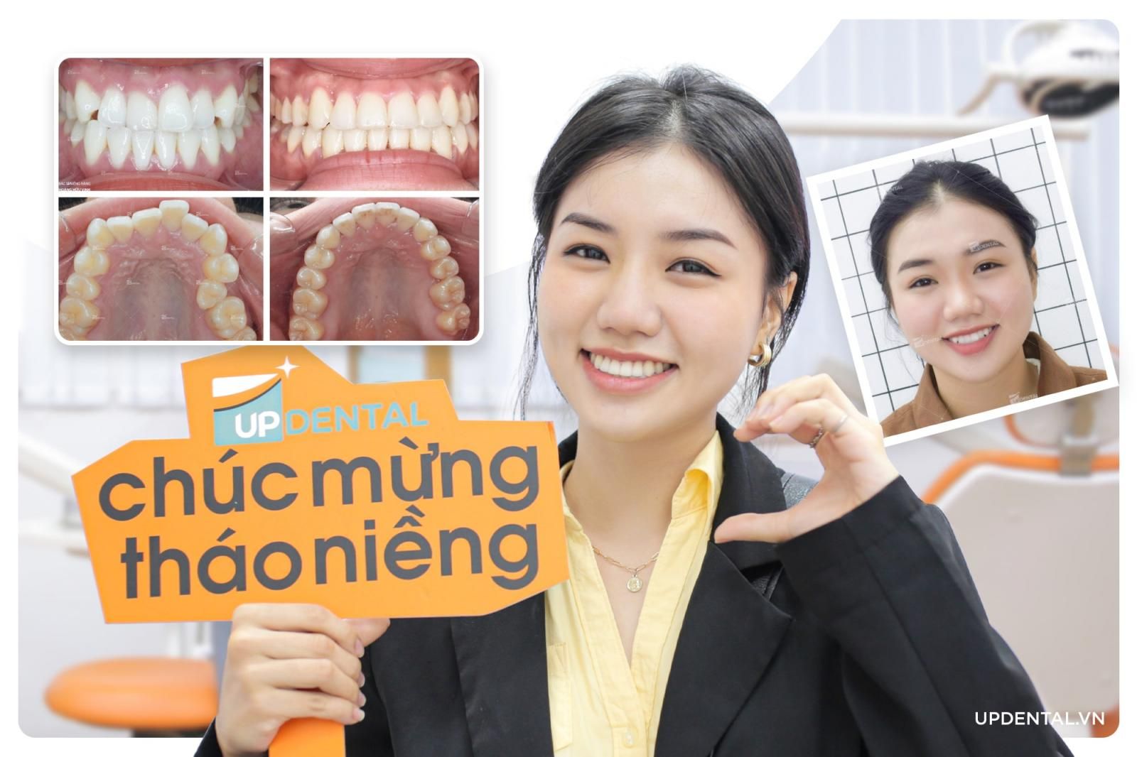 ảnh trước và sau khi niềng răng