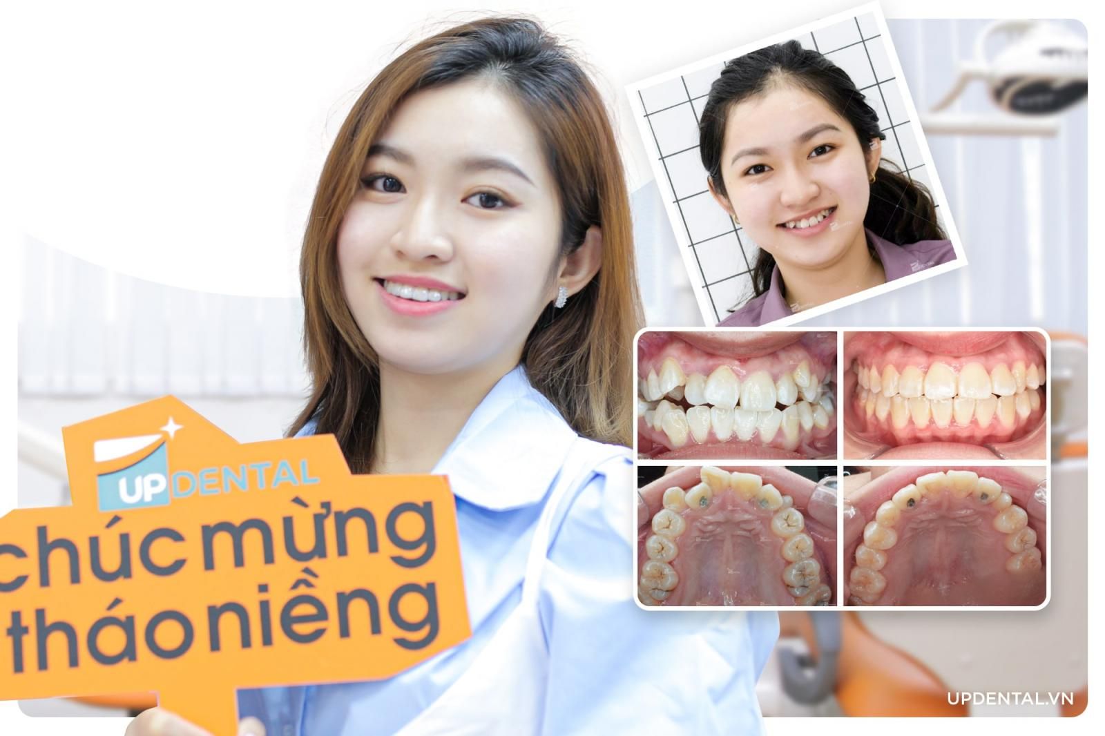 ảnh trước và sau khi niềng răng