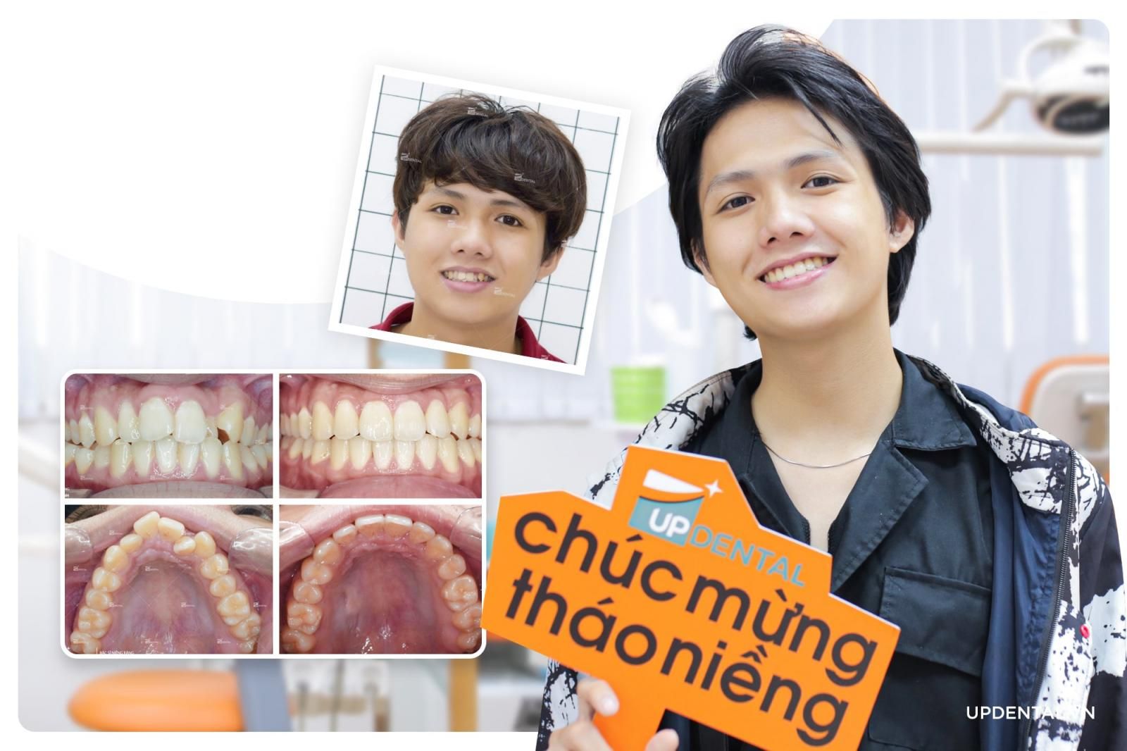 ảnh trước và sau khi niềng răng