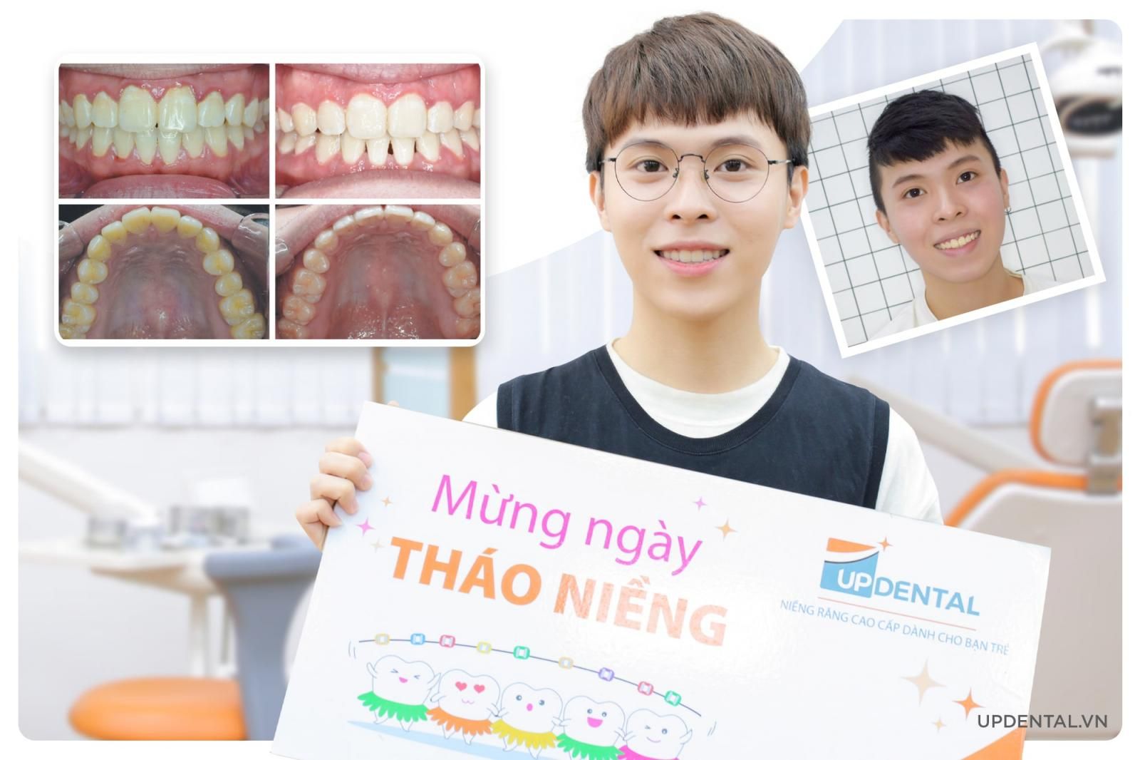 ảnh trước và sau khi niềng răng